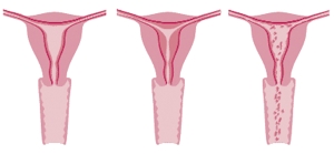 L'uterus